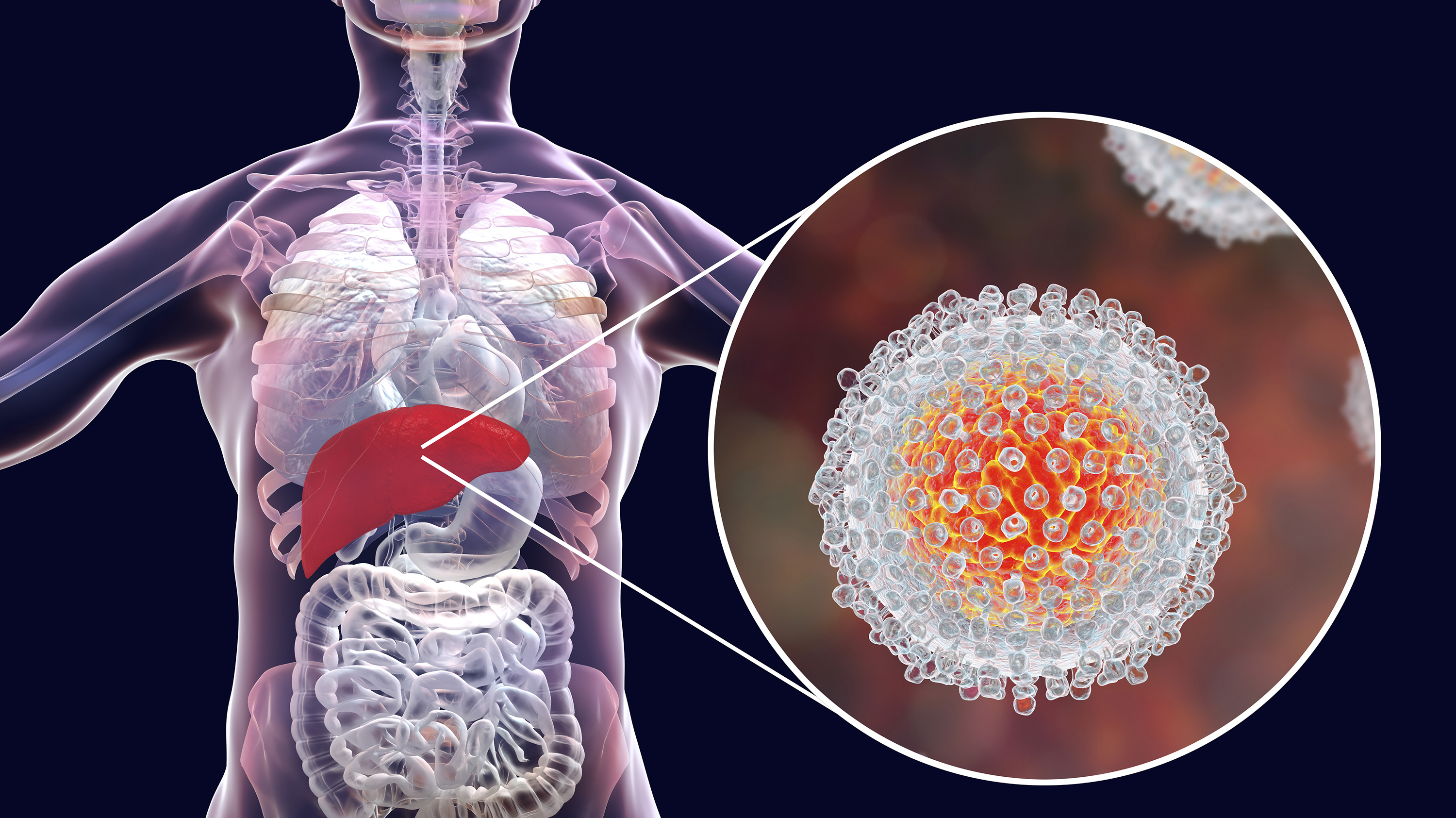 Poverty trap: 70 million in Africa infected with viral hepatitis with number growing rapidly