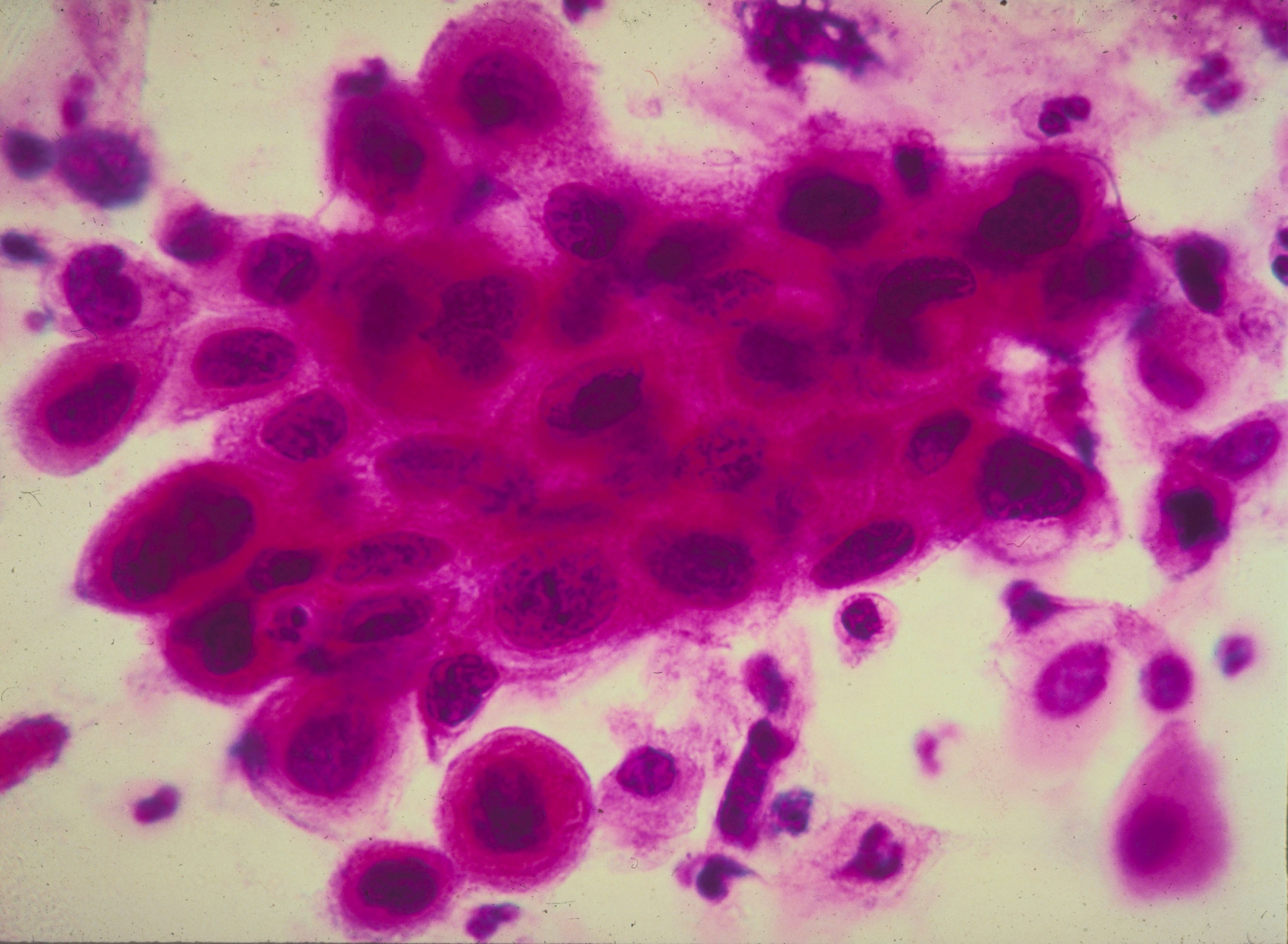 What is cervical cancer and how can it be prevented? Answers to key questions