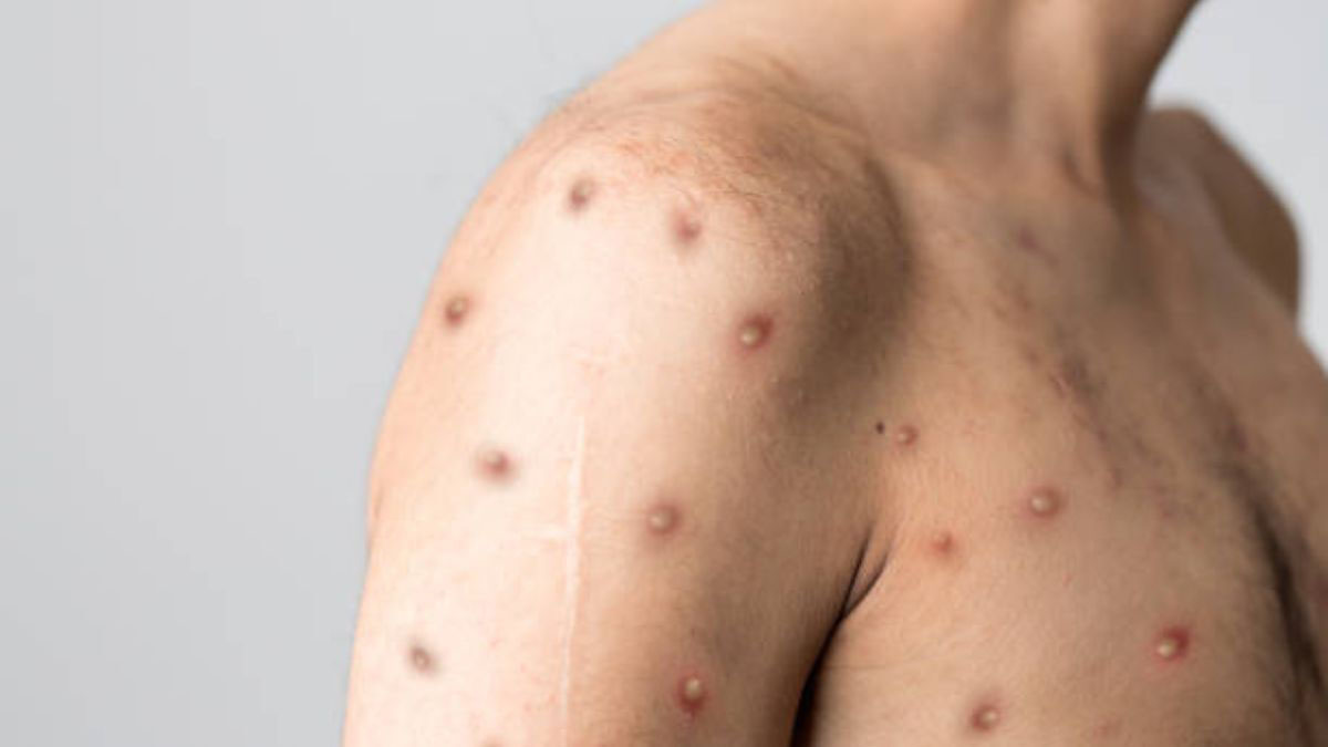 No mpox jabs for SA yet, but WHO and Africa CDC will help us fund the fight against the outbreak