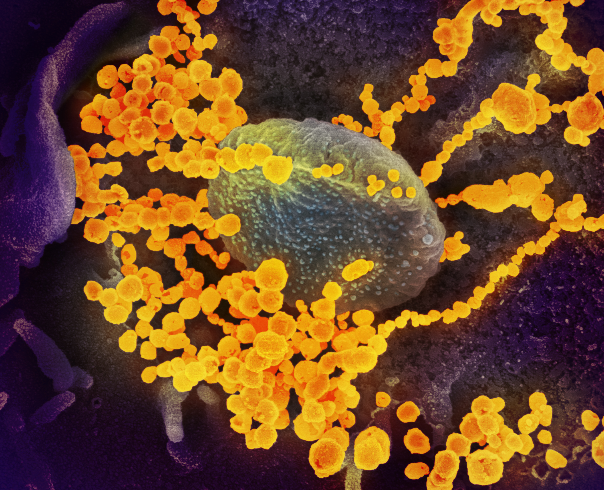 Covid-19: High prevalence found in Cape Town antibody study