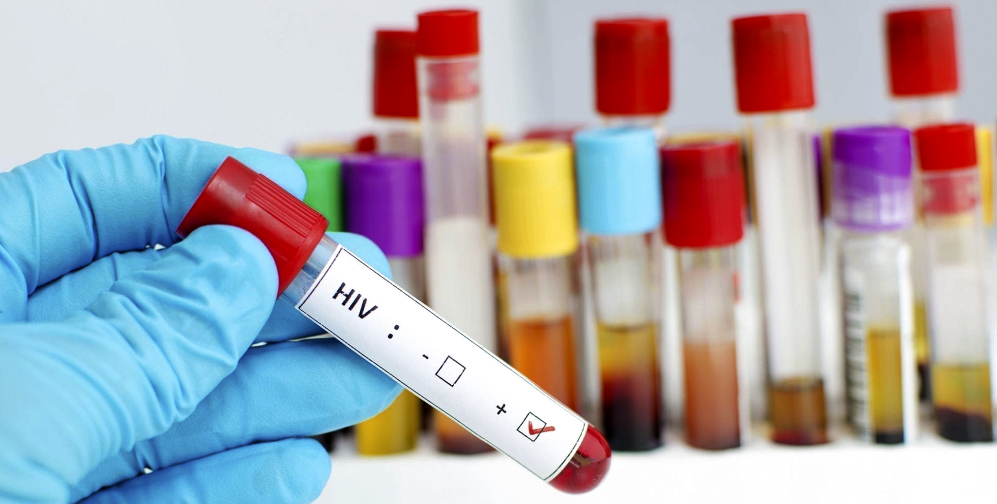 HIV death rate in SA men much higher than in women