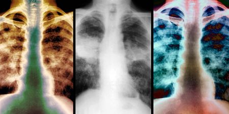 Tshiamiso Trust’s frustrating struggle for silicosis compensation for ex-mine workers and their families