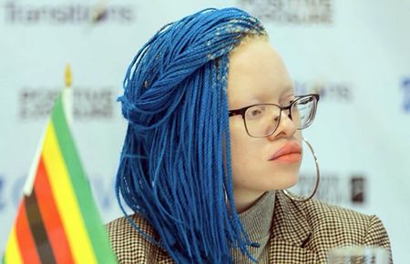 Challenging prejudice and normalising People With Albinism is the missing key, says activist