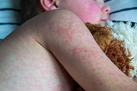 Cases of rubella spike countrywide while diphtheria hits Western Cape despite being preventable by vaccination
