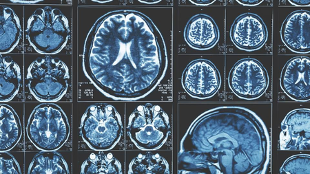 How does COVID affect the brain? Two neuroscientists explain