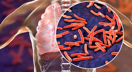 Shorter treatment regimens for TB offer hope but need urgent implementation