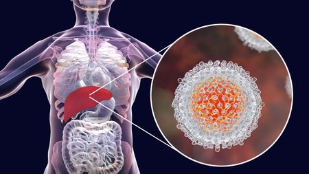 Poverty trap: 70 million in Africa infected with viral hepatitis with number growing rapidly