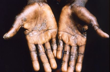 The mpox outbreak’s disturbing Covid-19 echoes in Africa